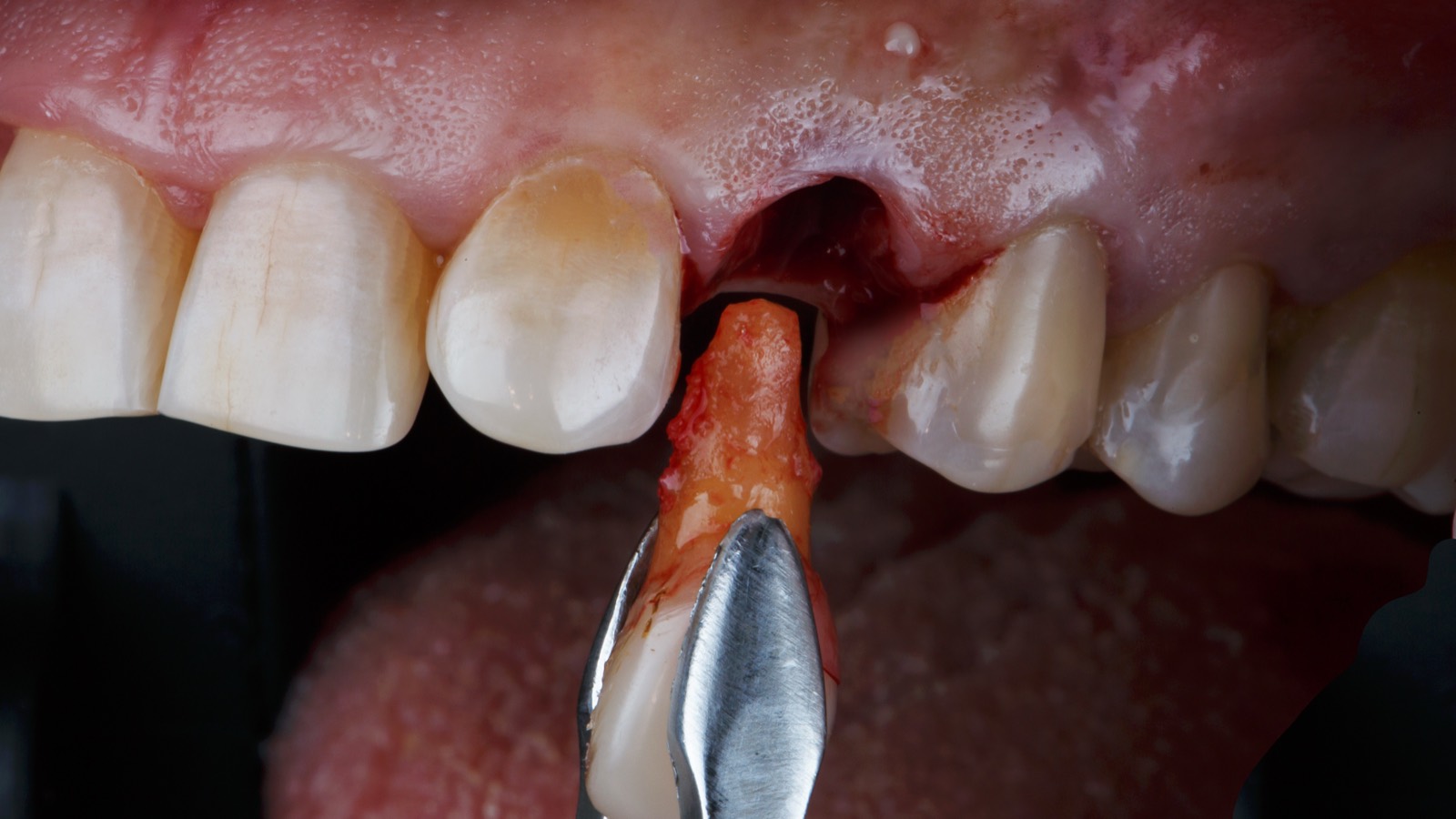 Tooth Autotransplantation