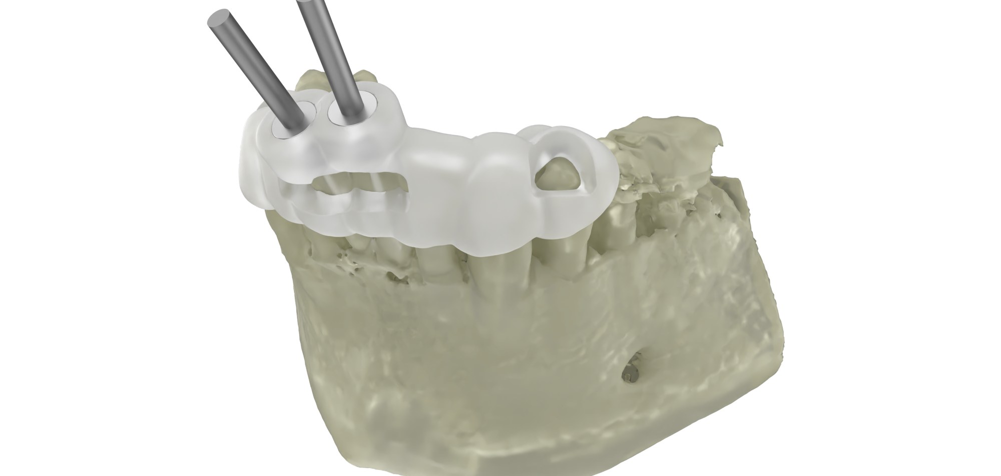 3D-printed guided endodontic access template with drill sleeves positioned over a dental model