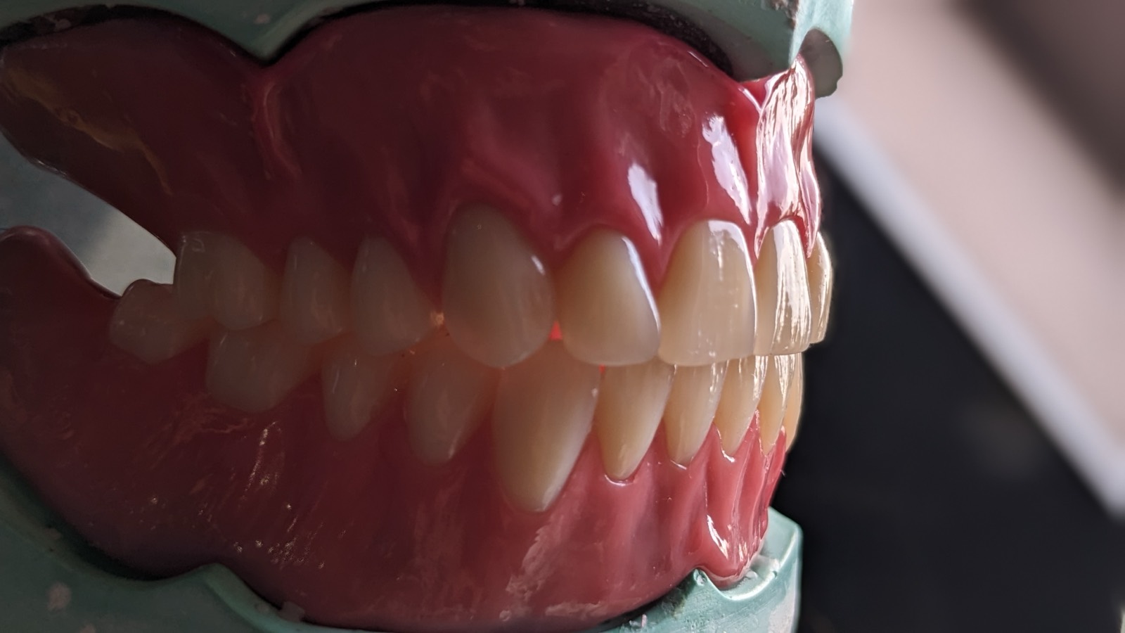Digital Complete Denture